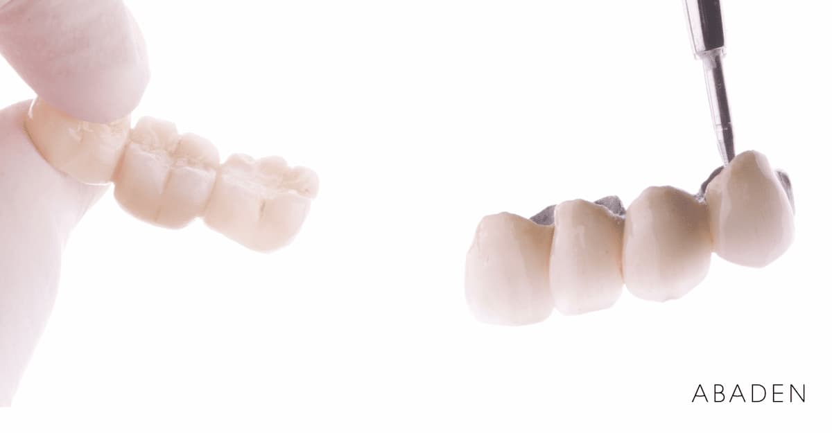 ¿Qué tipos de puentes dentales existen? 