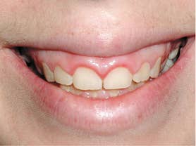 Caso clínico abaden dentistas Mercè Antes