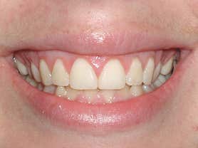 Caso clínico abaden dentistas Mercè Después