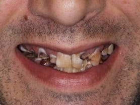 Caso clínico abaden dentistas Raul H Antes