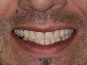 Caso clínico abaden dentistas Raul H Después