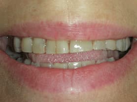 Caso clínico abaden dentistas Núria Antes
