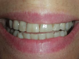 Caso clínico abaden dentistas Núria Después