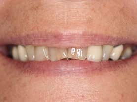 Caso clínico abaden dentistas María Antes