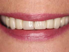 Caso clínico abaden dentistas María Después