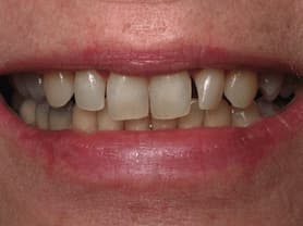 Caso clínico abaden dentistas Sara Antes