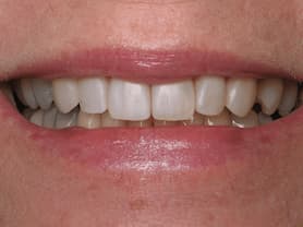 Caso clínico abaden dentistas Sara Después
