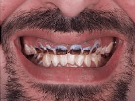 Caso clínico abaden dentistas Juanjo Antes