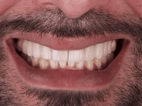 Caso clínico abaden dentistas Juanjo Después