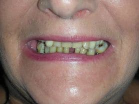 Caso clínico abaden dentistas Isabel Antes