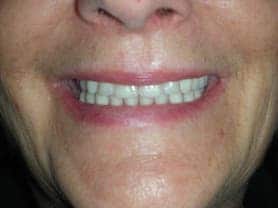 Caso clínico abaden dentistas Isabel Después