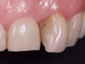 Caso clínico abaden dentistas Angeles Antes