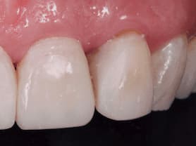 Caso clínico abaden dentistas Angeles Después