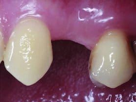 Caso clínico abaden dentistas Ramón Antes