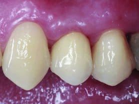 Caso clínico abaden dentistas Ramón Después