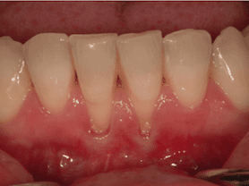 Caso clínico abaden dentistas Patricia Antes
