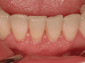 Caso clínico abaden dentistas Patricia Después