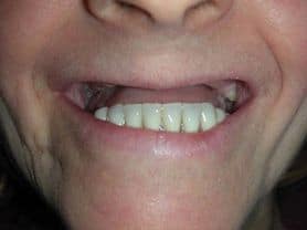 Caso clínico abaden dentistas Juana Antes