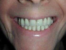 Caso clínico abaden dentistas Juana Después