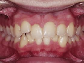 Caso clínico abaden dentistas Paz Antes