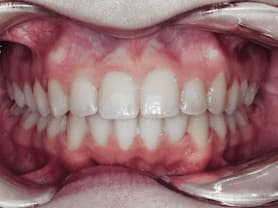 Caso clínico abaden dentistas Paz Después