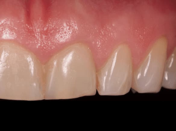 Caso clínico abaden dentistas Manuel Antes
