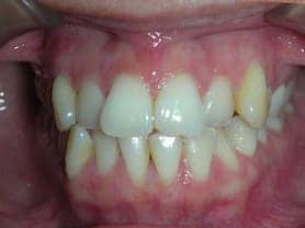 Caso clínico abaden dentistas Mónica Antes