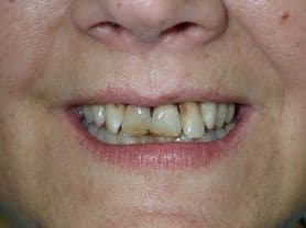 Caso clínico abaden dentistas Pilar Antes