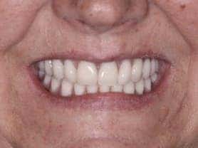 Caso clínico abaden dentistas Pilar Después