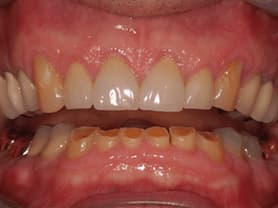 Caso clínico abaden dentistas Pablo Antes