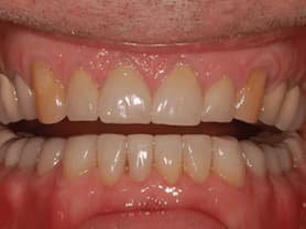 Caso clínico abaden dentistas Pablo Después