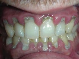 Caso clínico abaden dentistas Manuel Antes