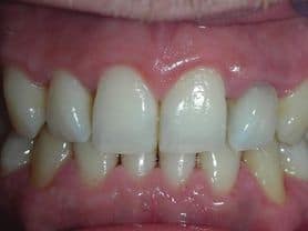 Caso clínico abaden dentistas Manuel Después