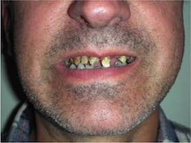 Caso clínico abaden dentistas Jose Manuel Antes