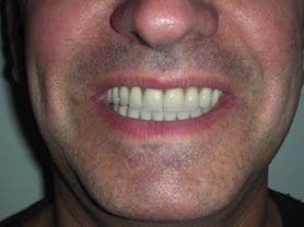 Caso clínico abaden dentistas Jose Manuel Después