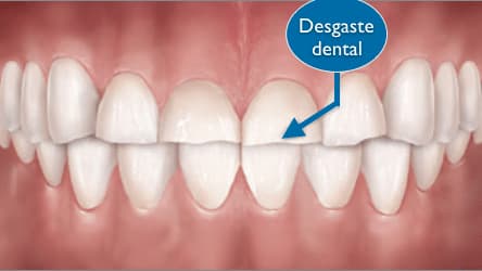 desgaste dental