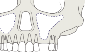 Implantes dentales sin hueso