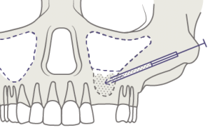Implantes dentales sin hueso