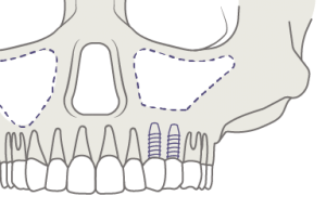 Implantes dentales sin hueso