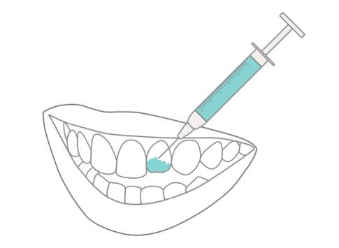 4. Preparación
