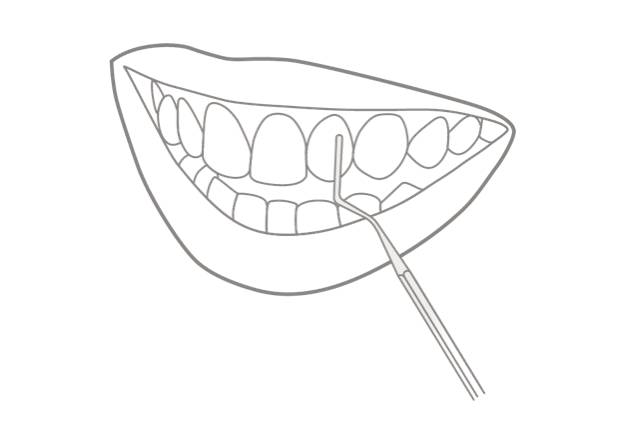 5. Moldeado del composite 
