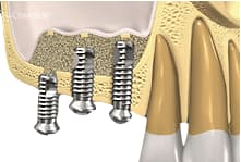 3. Colocación de los implantes dentales