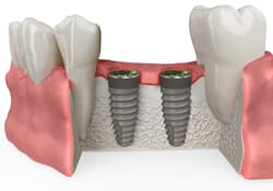  3. Colocación de los implantes dentales