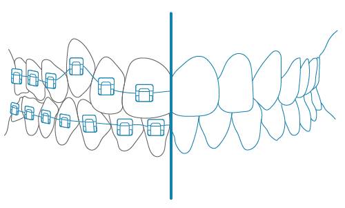 2. Colocación de brackets Damon