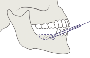 Implantes dentales sin hueso
