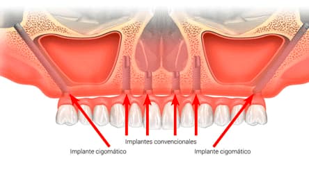 Implantes cigomáticos