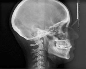 Telerradiografía lateral de cráneo