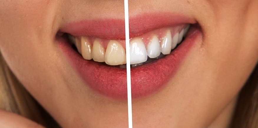 «Oil Pulling», enjuague bucal con aceite de coco