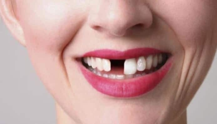 Consecuencias de la falta de dientes