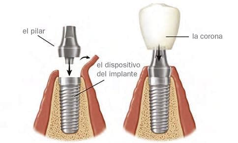 ¿Cuáles son las partes de un implante dental?